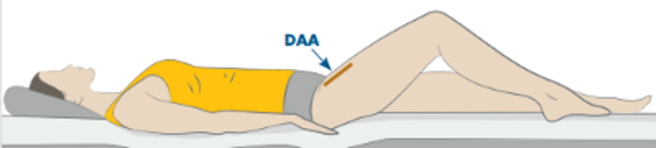 direct anterior approach